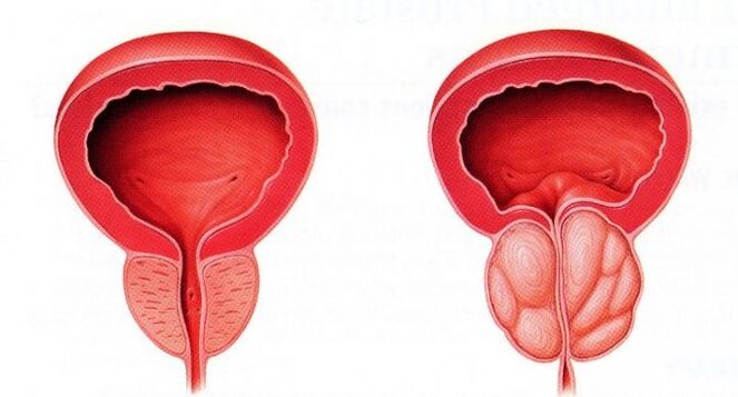 gezonde en ontstoken prostaat met chronische prostatitis