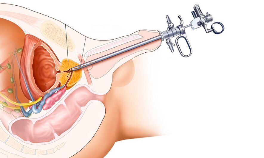Chirurgische behandeling van prostatitis