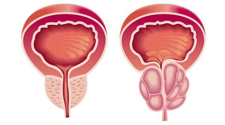 Gezonde en ontstoken prostaat met prostatitis