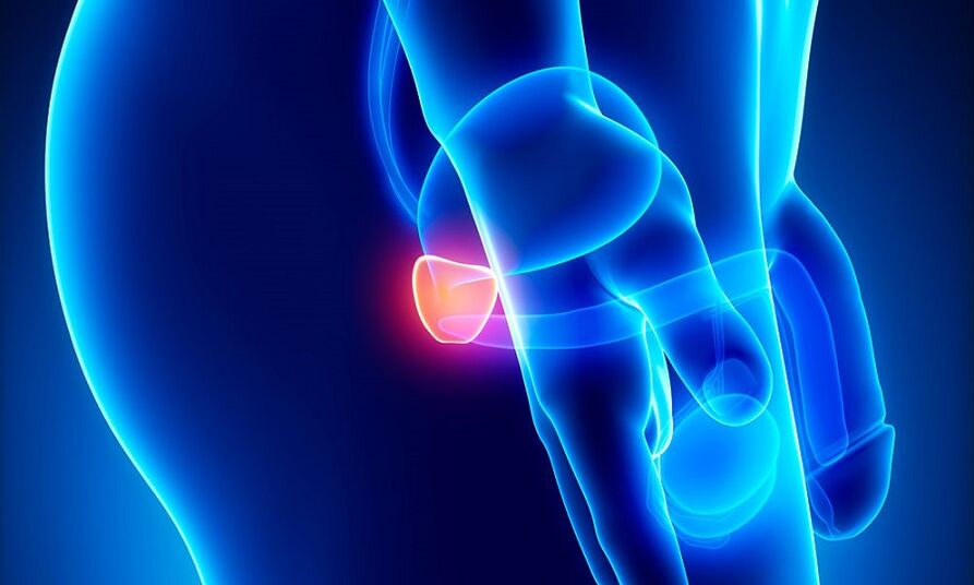 ontsteking van de prostaat met prostatitis