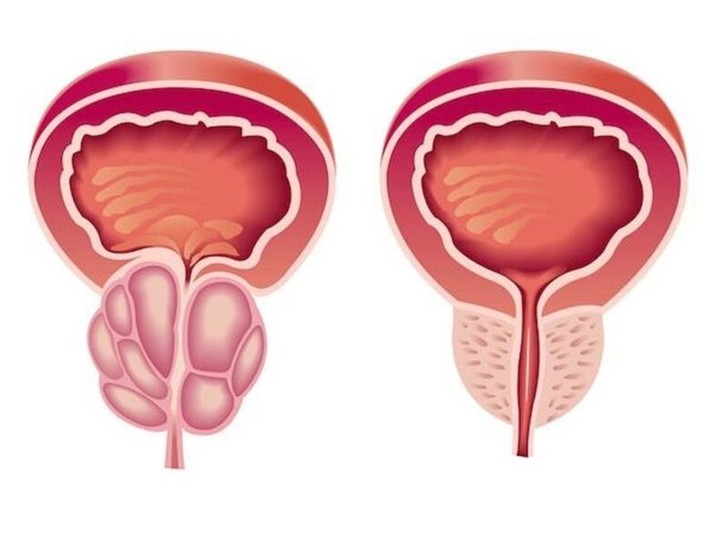 Hoe prostatitis eruit ziet